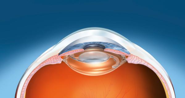 Cataractoperation